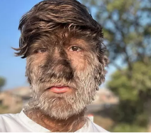 11 hipertrikoz vakasının tamamında  ortak özellik var!